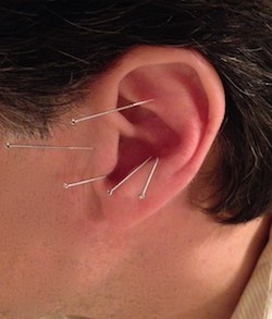 ear_acupuncture_hunger